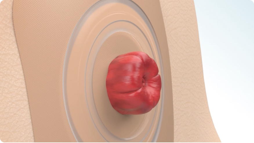 an illustration of a stoma
