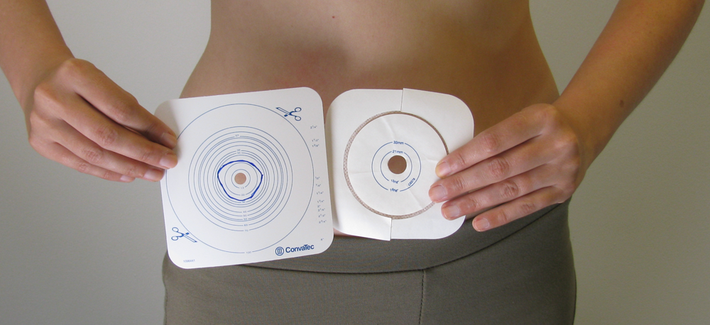 ConvaTec Esteem Synergy Versorgungswechsel Schritt f&uuml;r Schritt 01