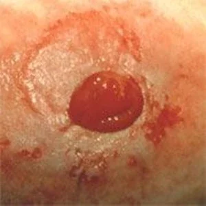 Irritert peristomale hud