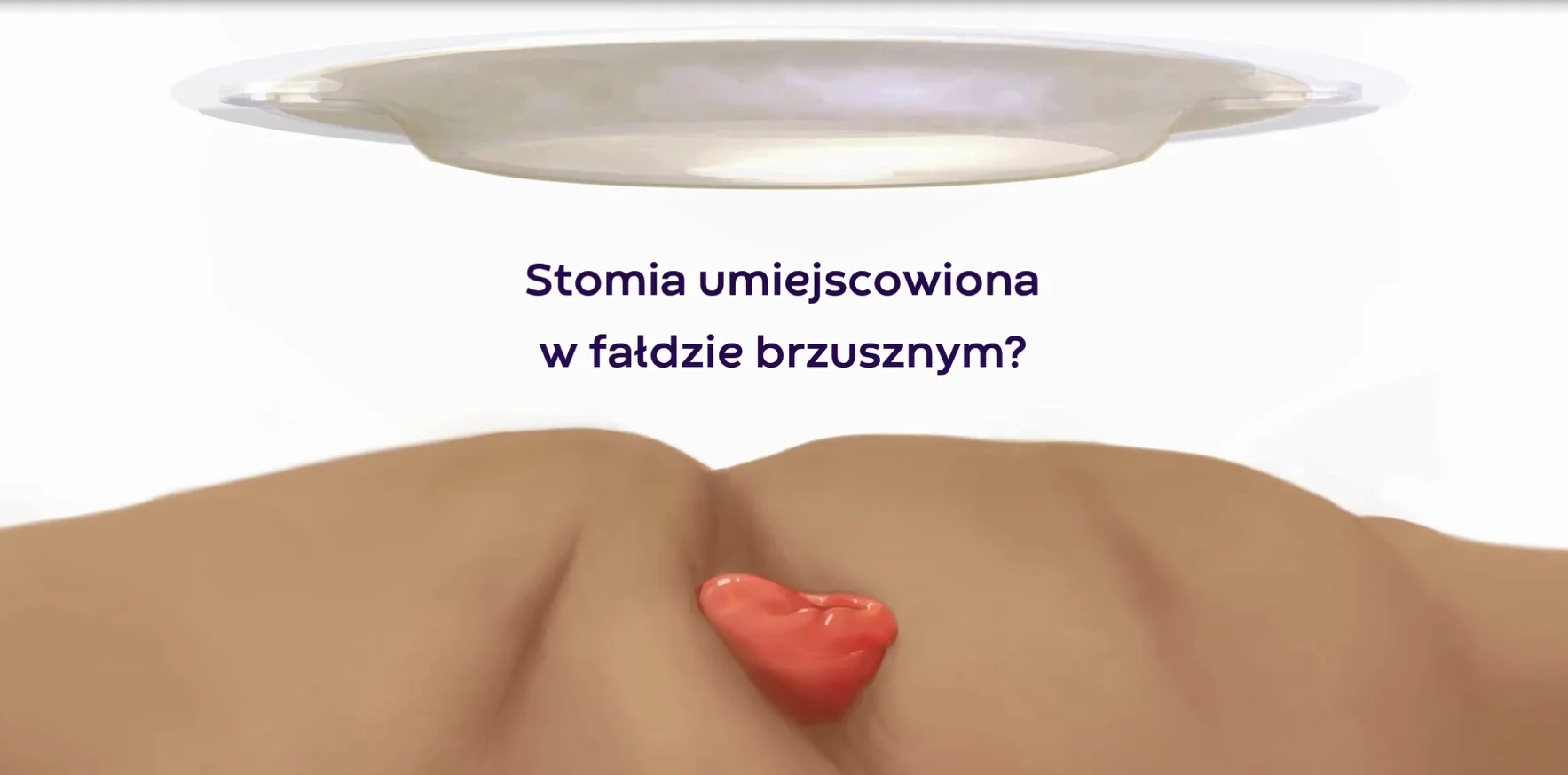 Film wyjaśniający napięcie obwodowe w celu spłaszczenia fałdów skórnych wokół stomii w celu niezawodnego uszczelnienia stomii.