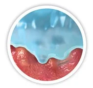 tegning af mikrokonturer til sårleje