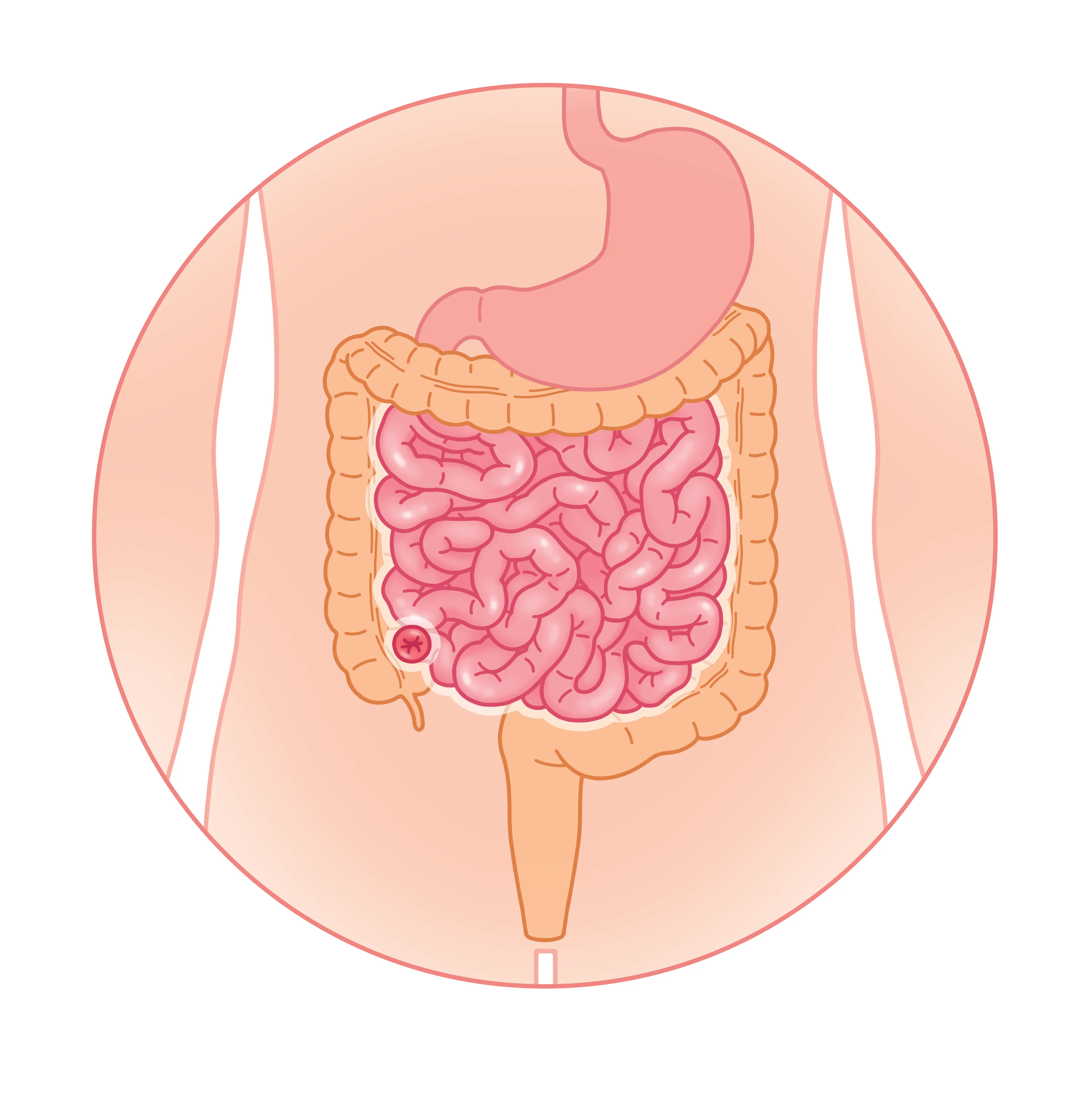Chirurgie d’iléostomie