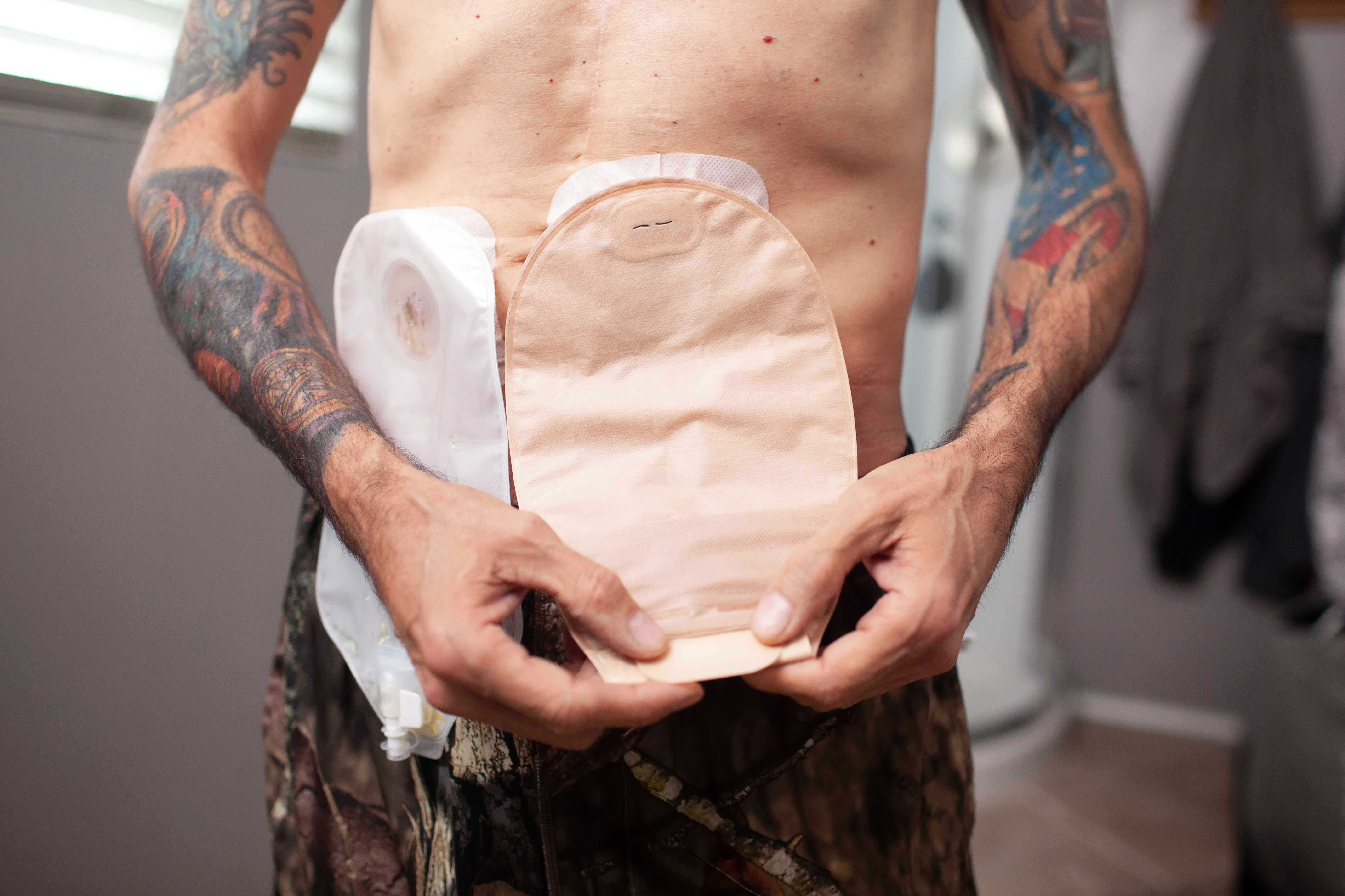 a close-up of a man with stoma pouches