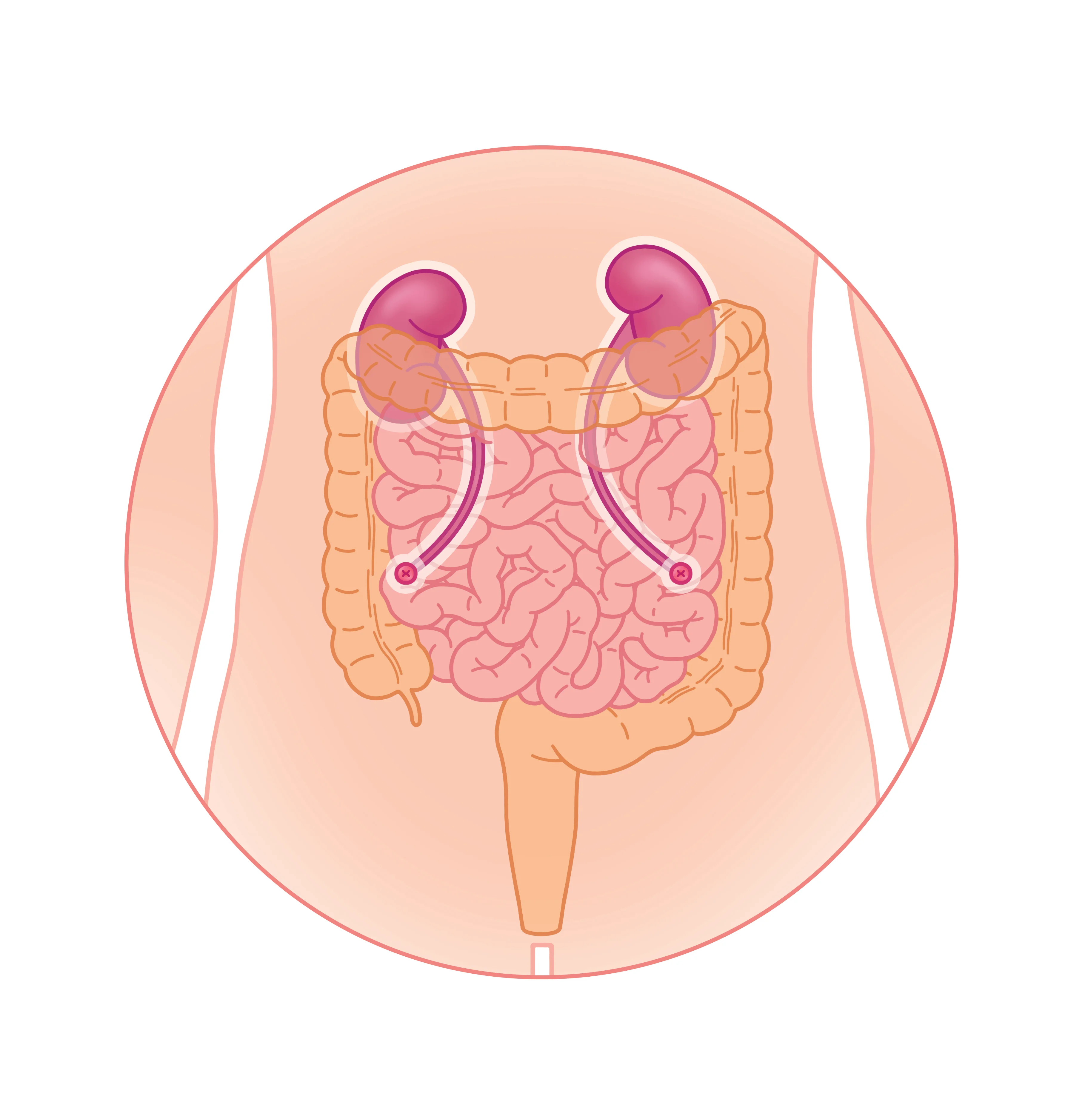 Ureterostomies cutan&eacute;es directes